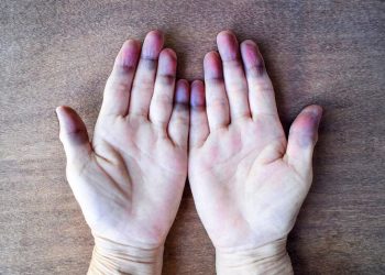 Bệnh tim: 3 triệu chứng xuất hiện trên da ít người để ý