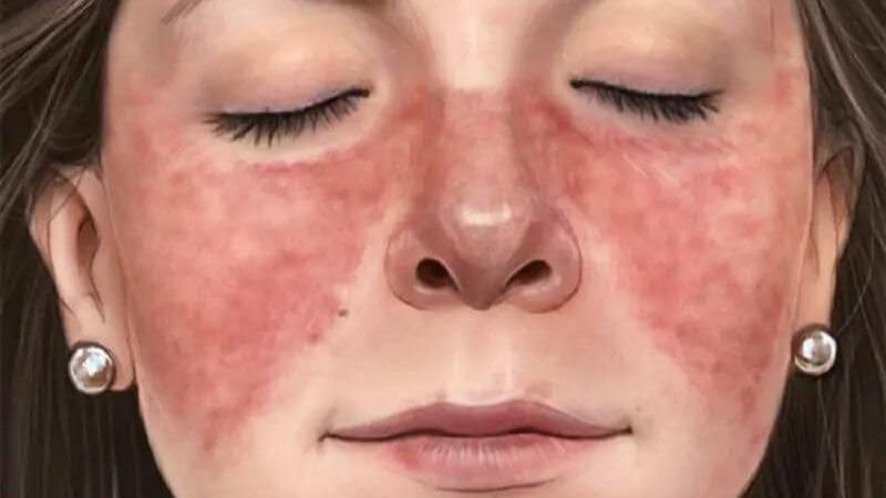 Lupus ban đỏ có thể xuất hiện triệu chứng đau nhức toàn thân Lupus ban đỏ có thể xuất hiện triệu chứng đau nhức toàn thân